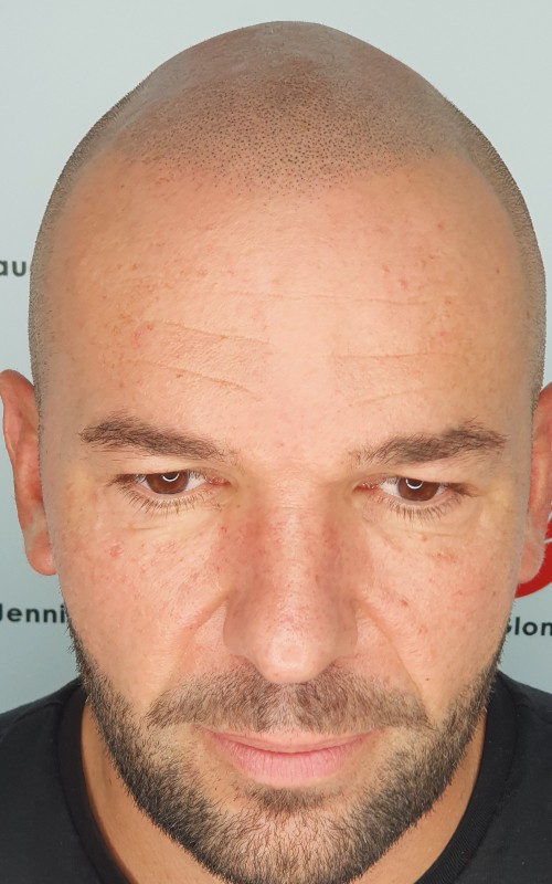 Après tricopigmentation