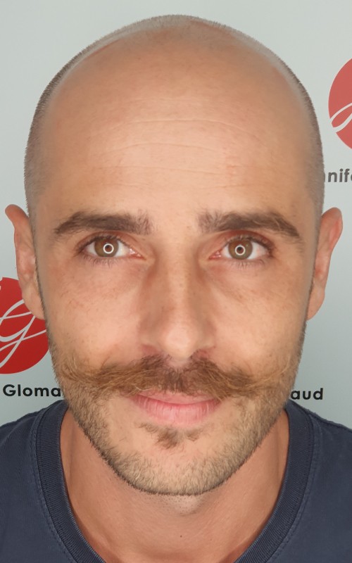 Avant tricopigmentation