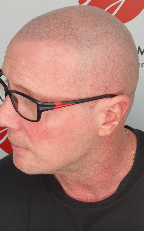 Après tricopigmentation