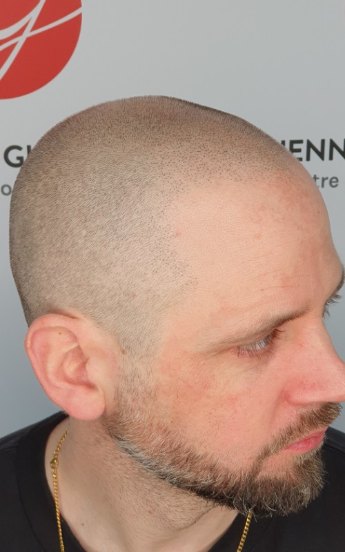 Après tricopigmentation