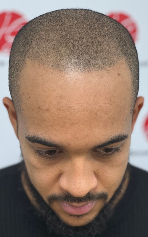 Après tricopigmentation