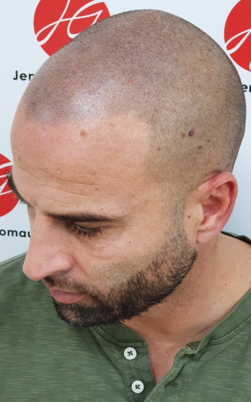 Après tricopigmentation