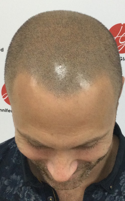 Après tricopigmentation