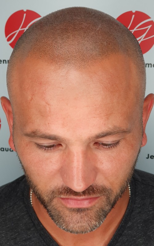 Après tricopigmentation