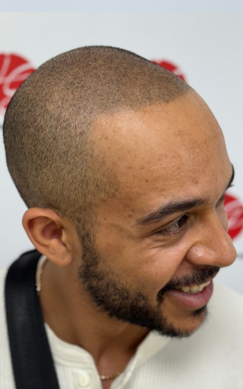 Après tricopigmentation