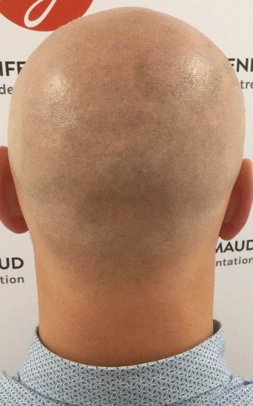Après tricopigmentation