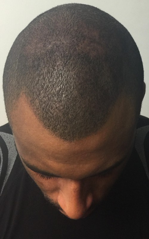 Après tricopigmentation