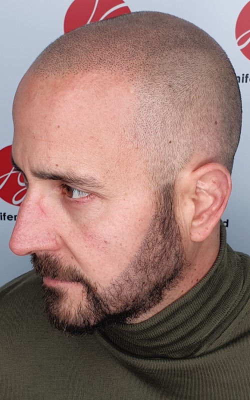 Après tricopigmentation