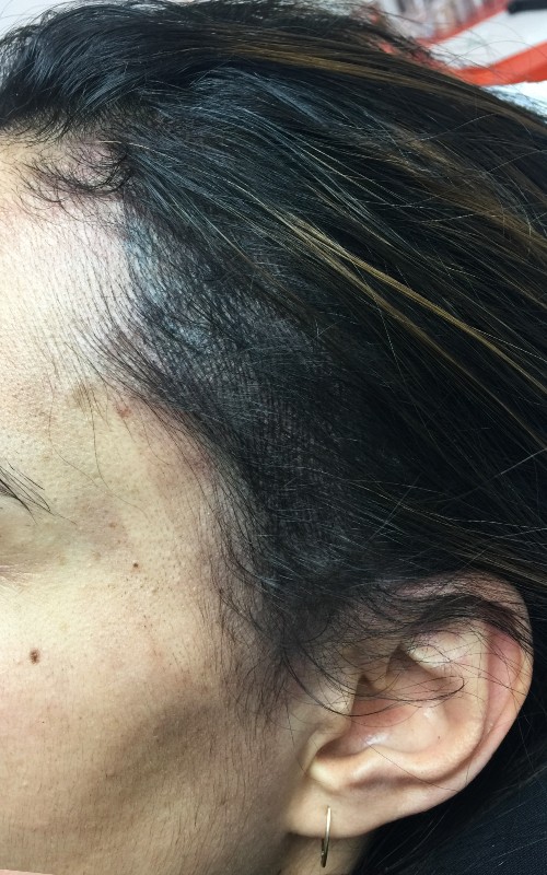 Après tricopigmentation