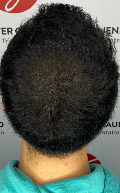 Après tricopigmentation