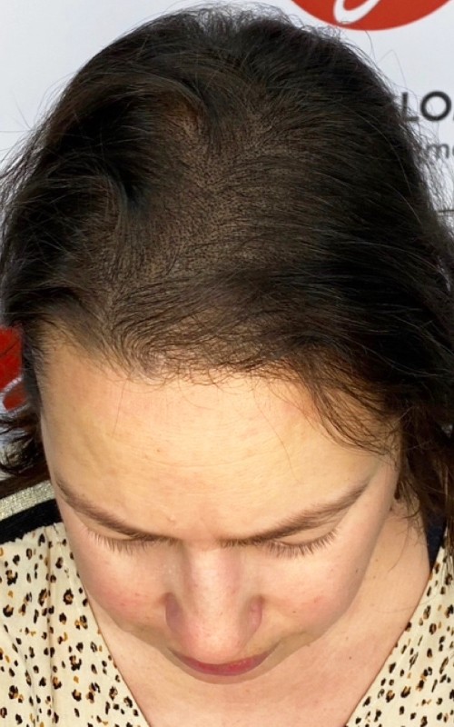 Après tricopigmentation