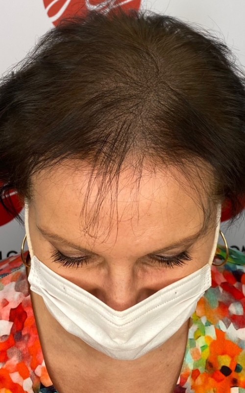 Après tricopigmentation