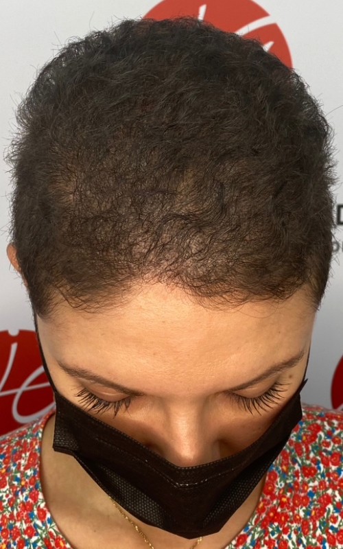 Après tricopigmentation