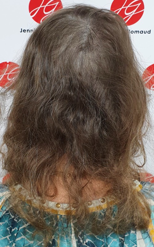 Après tricopigmentation