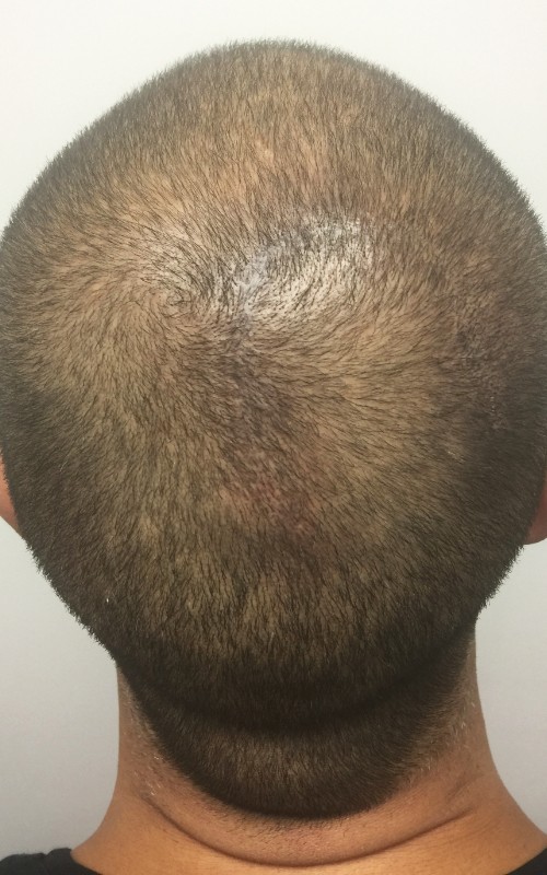 Après tricopigmentation