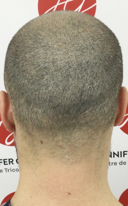 Après tricopigmentation