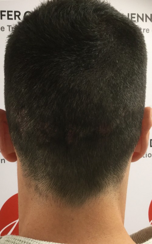 Après tricopigmentation