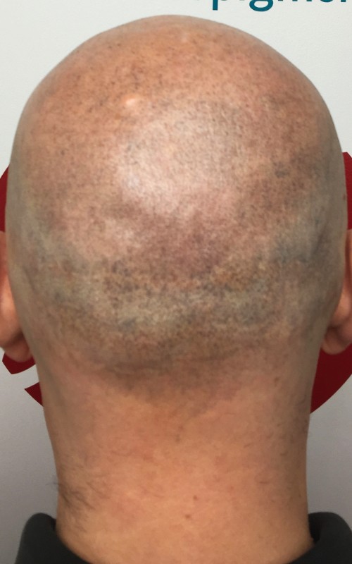 Après tricopigmentation