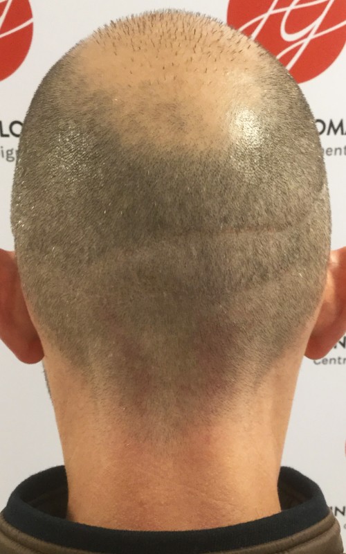 Après tricopigmentation