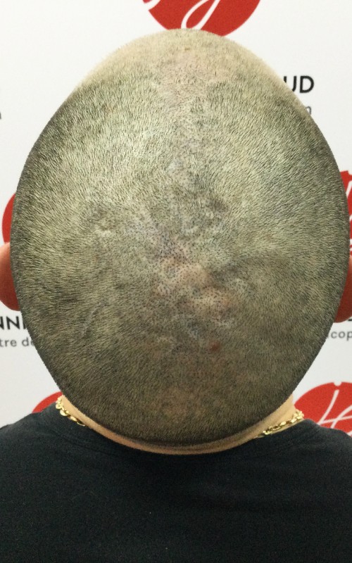 Après tricopigmentation