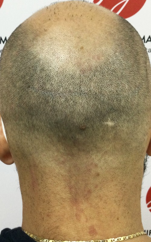 Après tricopigmentation