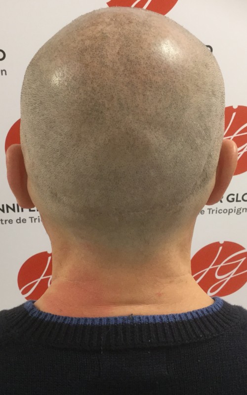 Après tricopigmentation