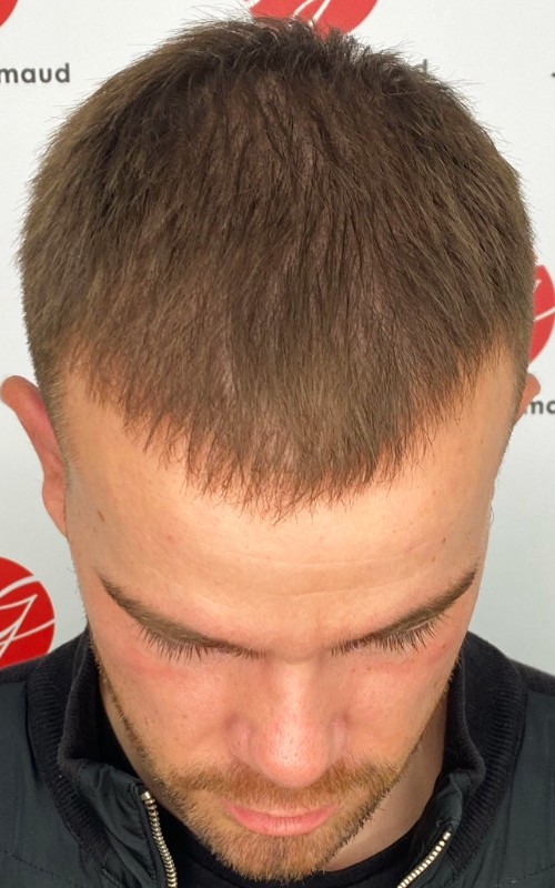 Après tricopigmentation