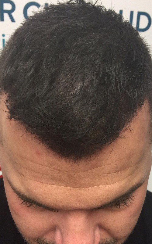 Après tricopigmentation