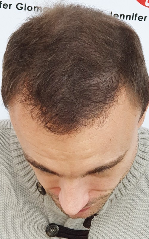 Après tricopigmentation