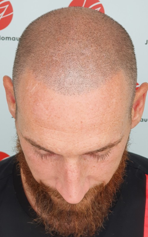 Après tricopigmentation