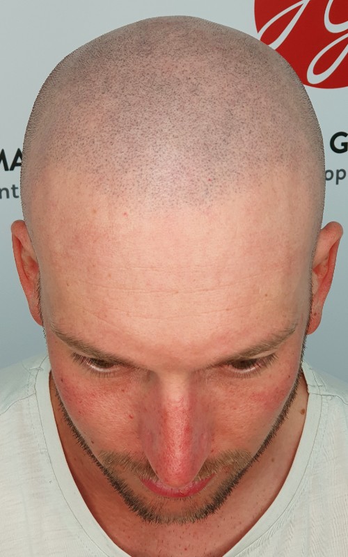 Après tricopigmentation