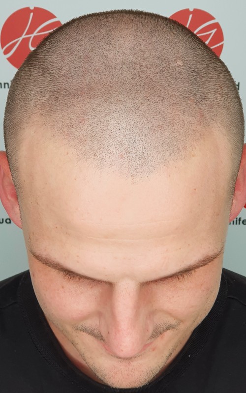 Après tricopigmentation