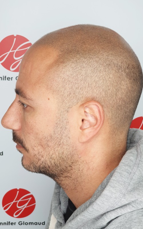 Après tricopigmentation