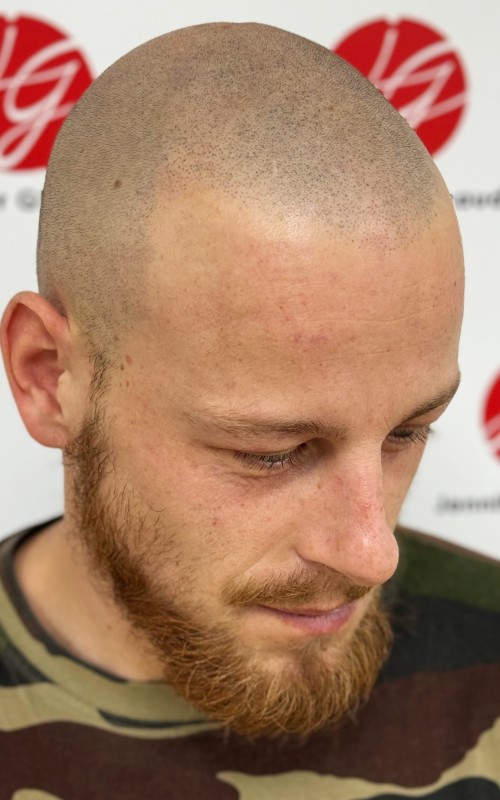 Après tricopigmentation