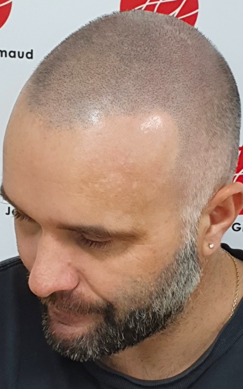 Après tricopigmentation