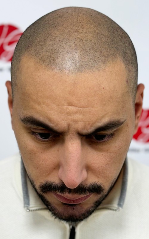 Après tricopigmentation