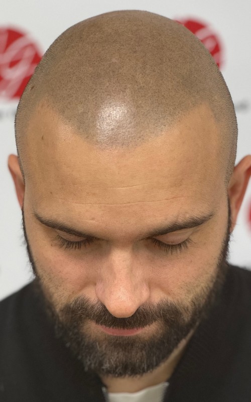 Après tricopigmentation