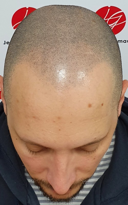 Après tricopigmentation