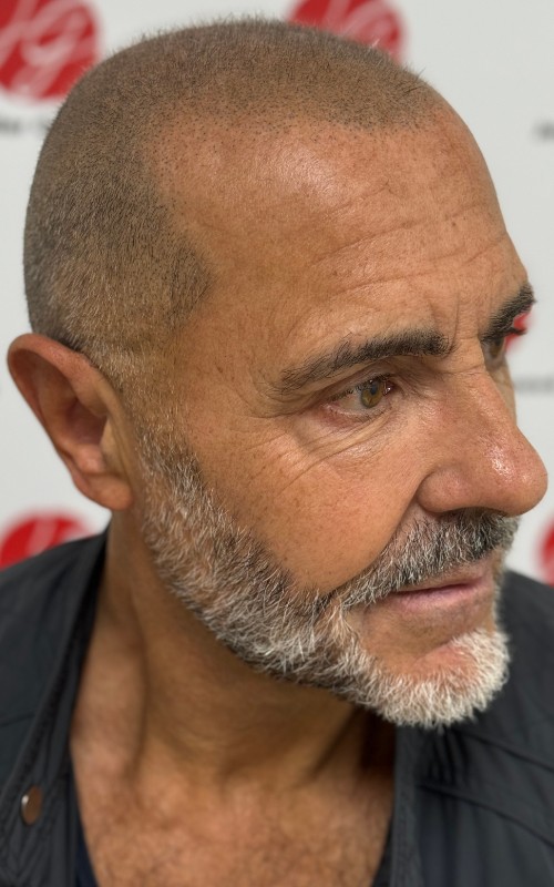 Après tricopigmentation