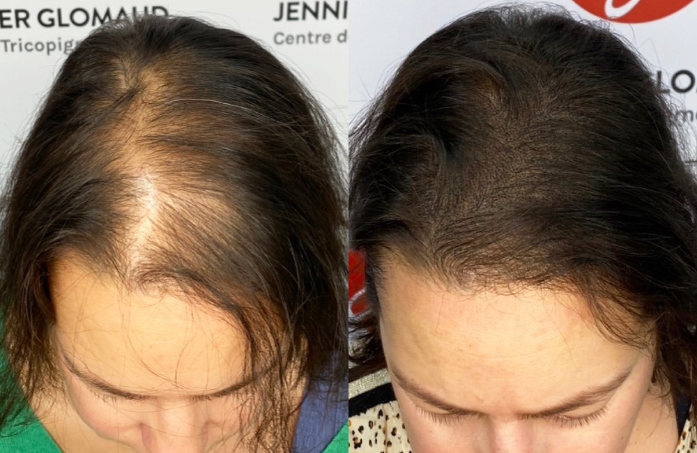Avant / Après d'une tricopigmentation pour femme effet densité - Centre Jennifer Glomaud