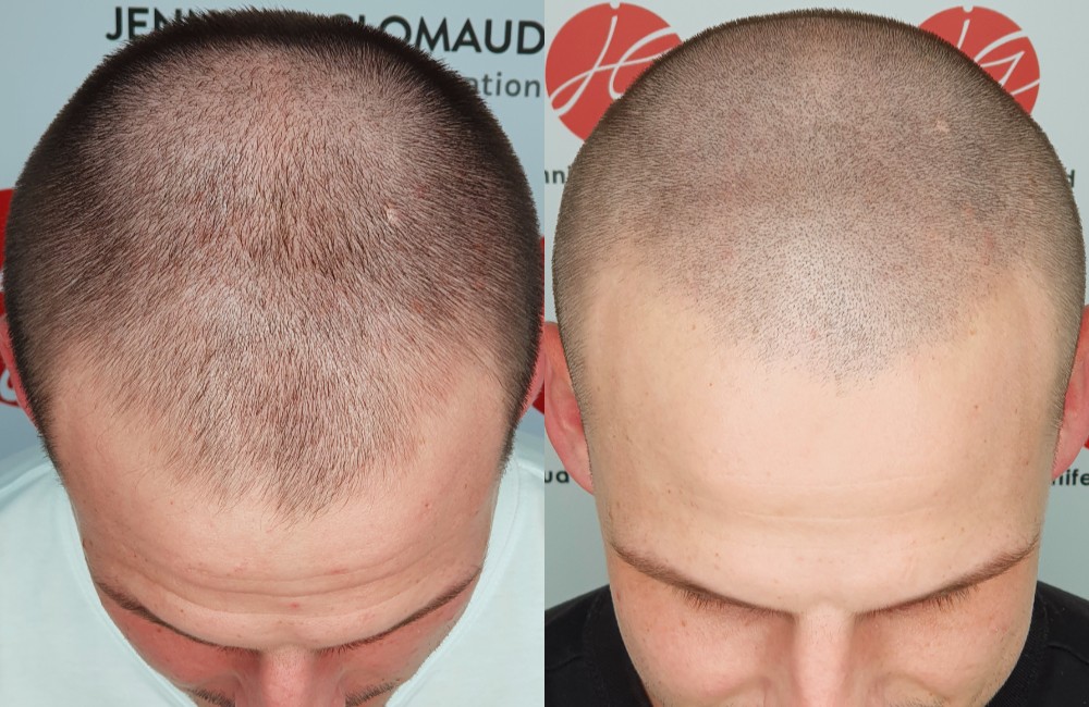 Avant / Après d'une tricopigmentation pour homme effet rasé - Centre Jennifer Glomaud