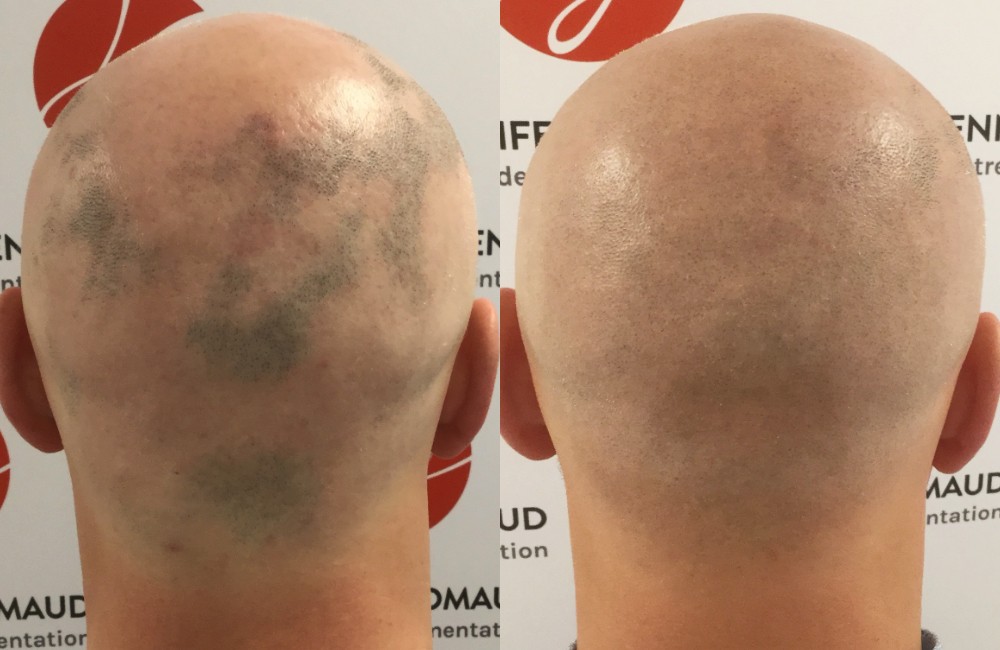 Avant / Après d'une tricopigmentation pour homme masquage d'une pelade - Centre Jennifer Glomaud