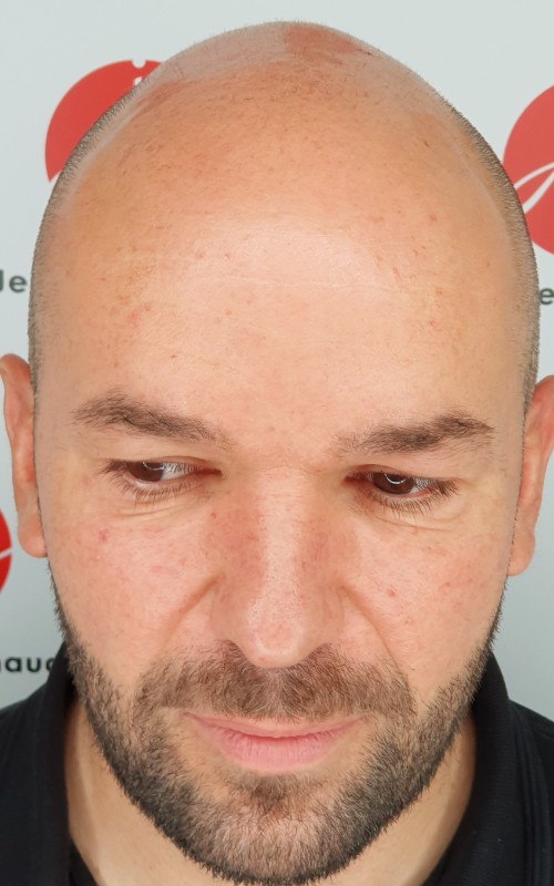 Avant tricopigmentation