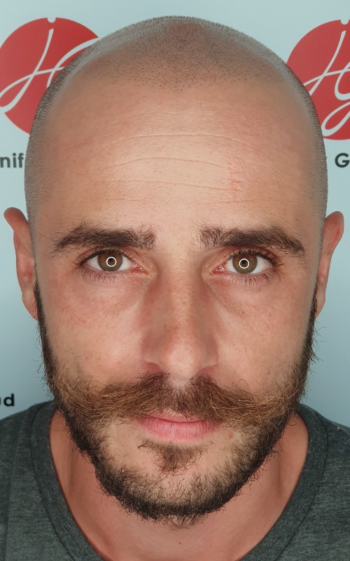 Après tricopigmentation