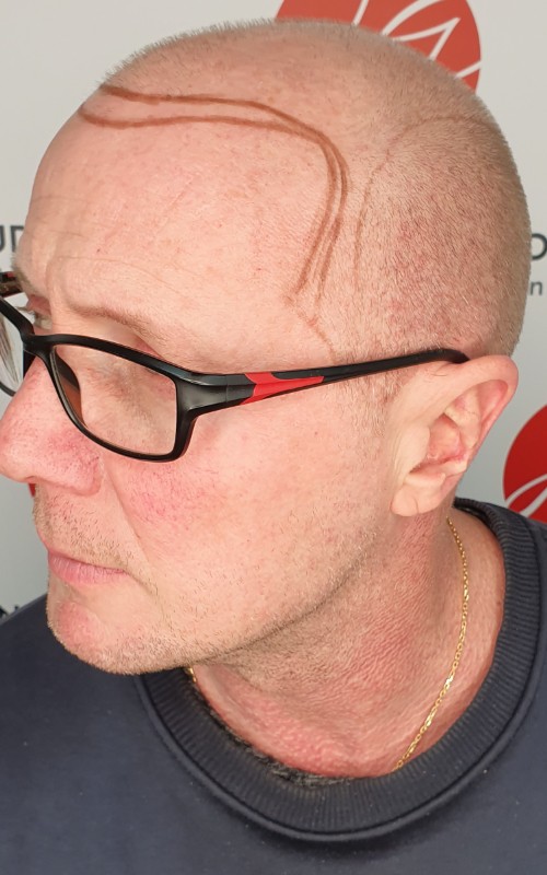 Avant tricopigmentation