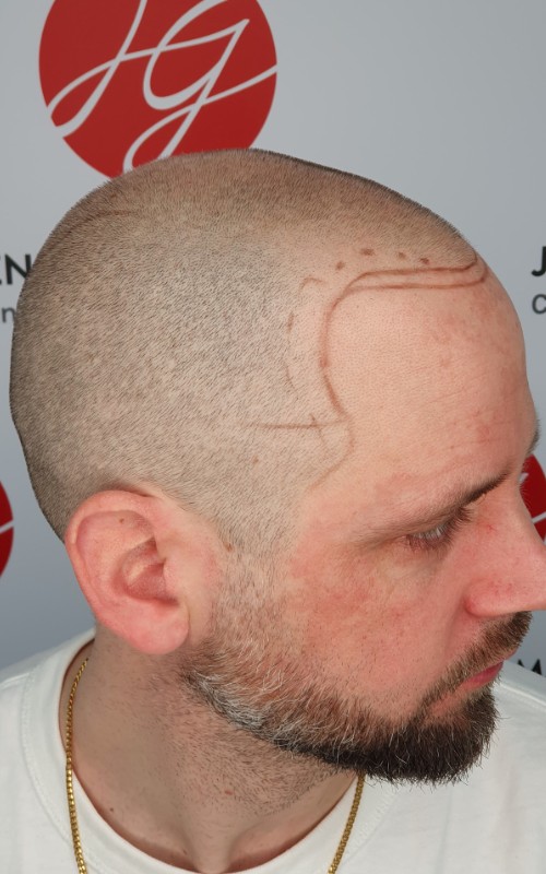 Avant tricopigmentation