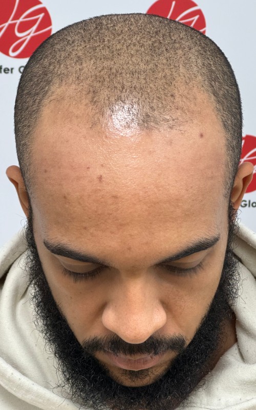 Avant tricopigmentation