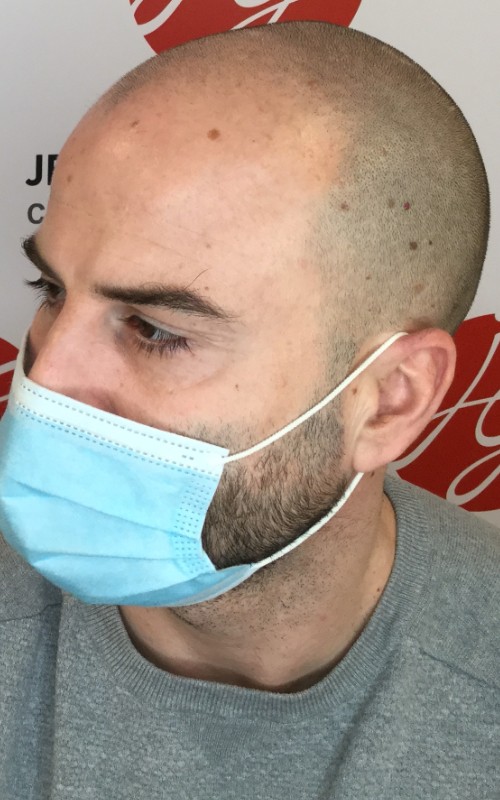 Avant tricopigmentation