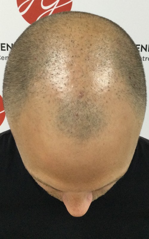 Avant tricopigmentation
