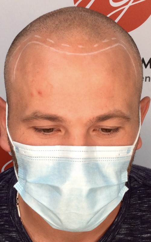 Avant tricopigmentation